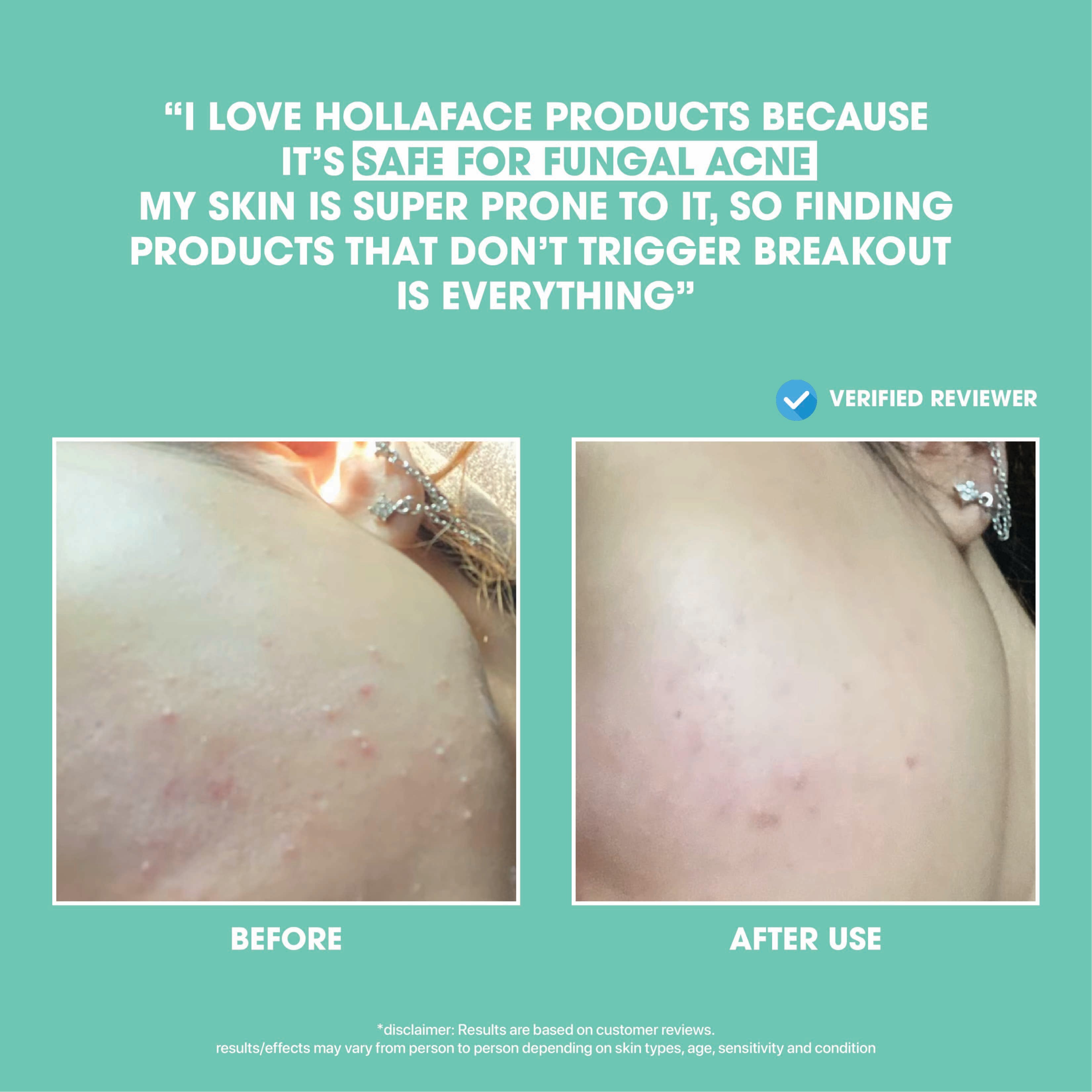 Anti-Acne Blemish Solution Set