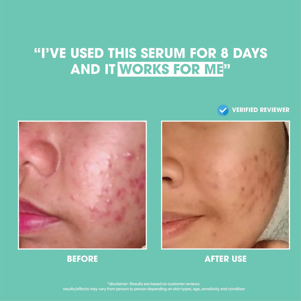 Anti-Acne Blemish Solution Set