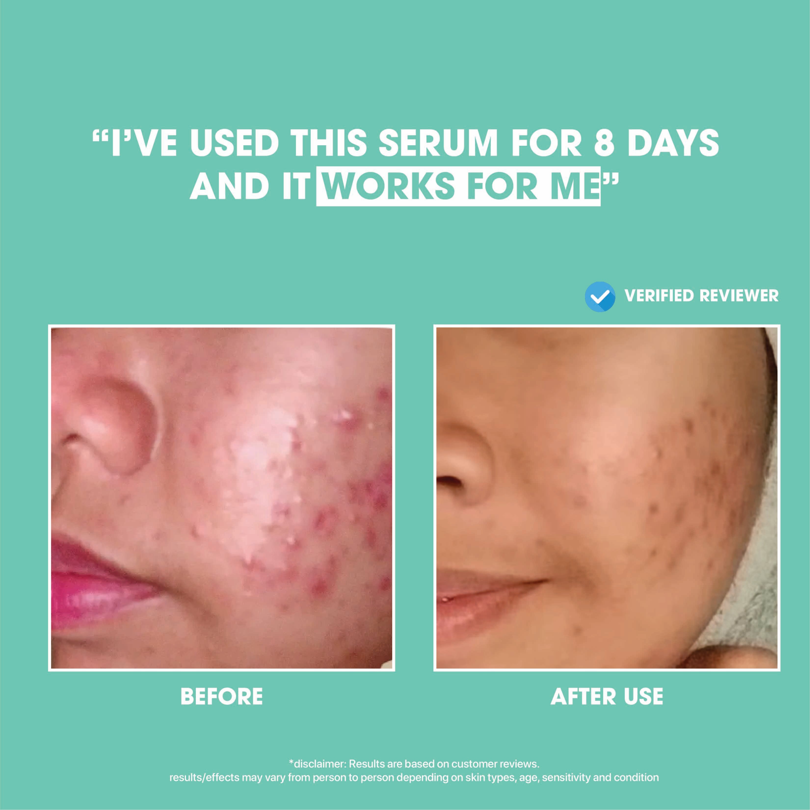 Anti-Acne Blemish Solution Set