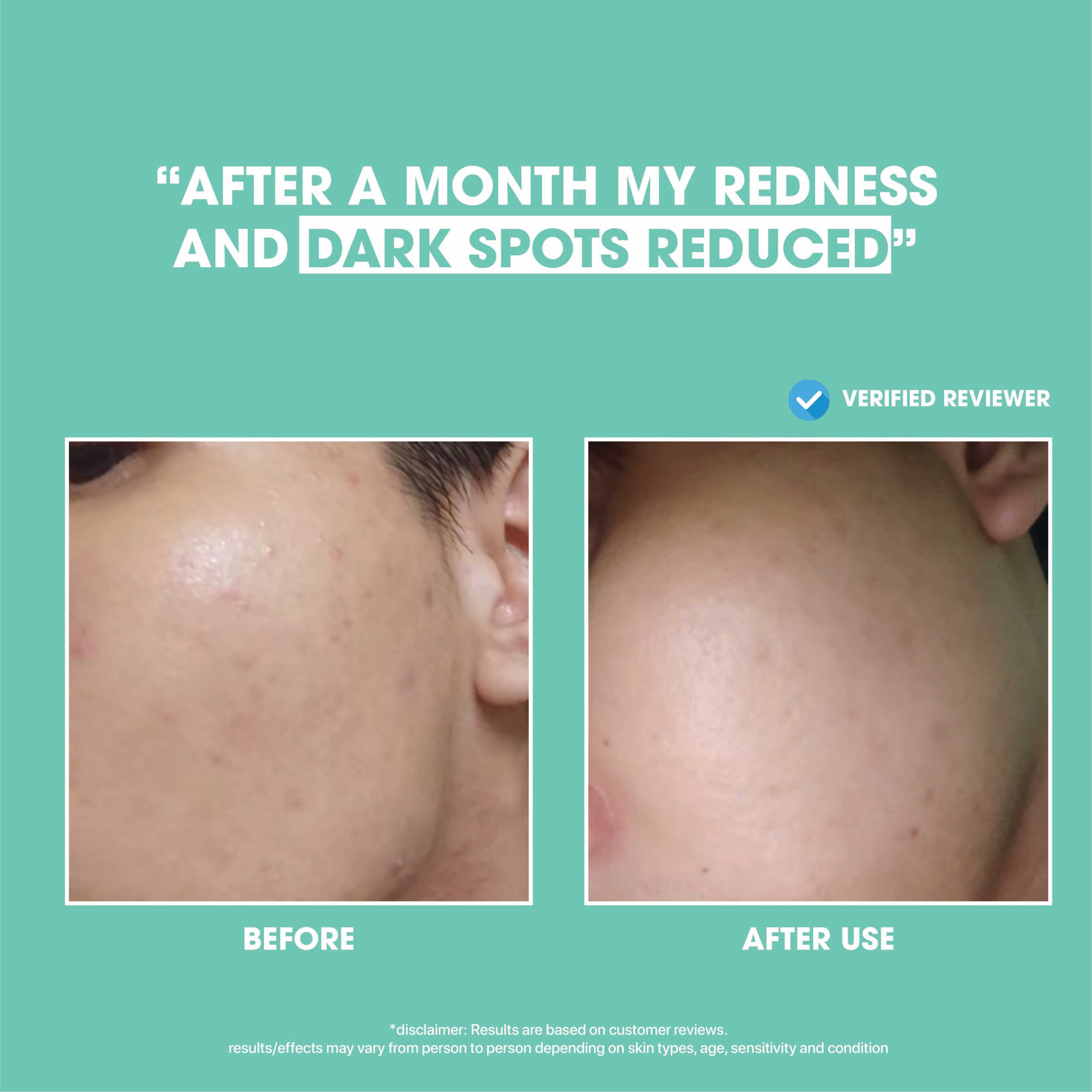 Anti-Acne Blemish Solution Set